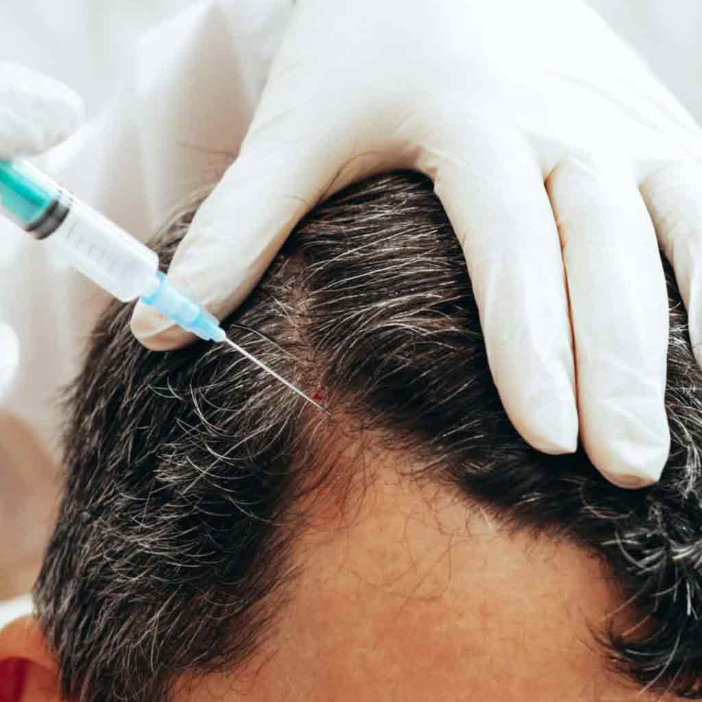 prp hair treatment in peshawar